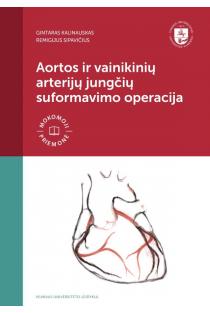 Aortos ir vainikinių arterijų jungčių suformavimo operacija | Gintaras Kalinauskas, Remigijus Sipavičius