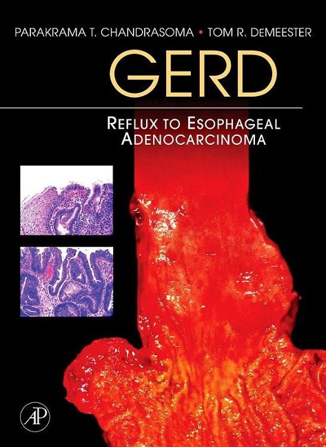 Gerd: Reflux to Esophageal Adenocarcinoma