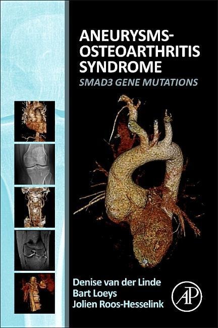 Aneurysms-Osteoarthritis Syndrome: Smad3 Gene Mutations