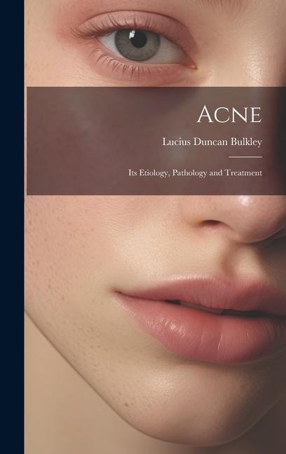 Acne: Its Etiology, Pathology and Treatment