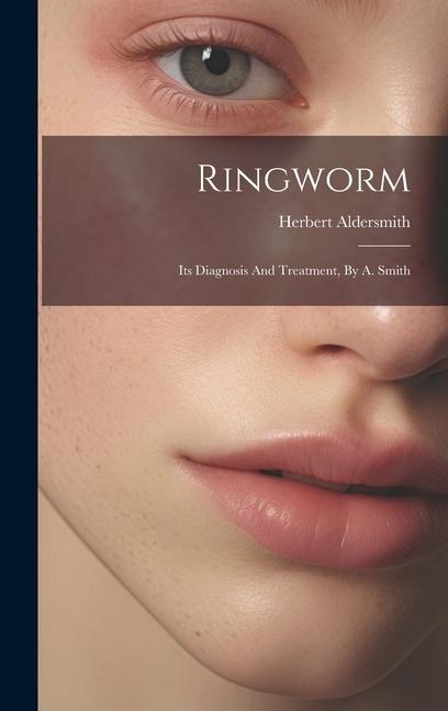 Ringworm: Its Diagnosis And Treatment, By A. Smith