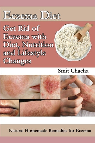 Eczema Diet - Get Rid of Eczema with Diet, Nutrition and Lifestyle Changes Natural Homemade Remedies for Eczema