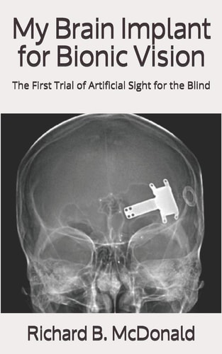 My Brain Implant for Bionic Vision The First Trial of Artificial Sight for the Blind