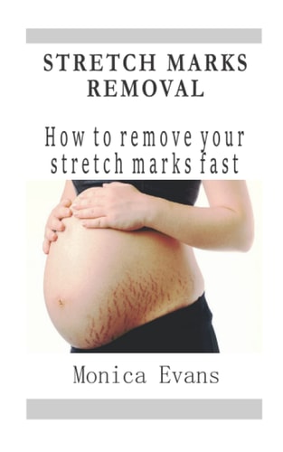 Stretch Marks Removal How to Remove Your Stretch Marks Fast
