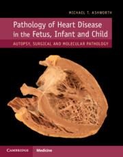 Pathology of Heart Disease in the Fetus, Infant and Child: Autopsy, Surgical and Molecular Pathology