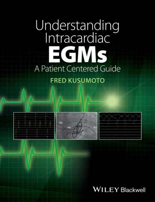 Understanding Intracardiac Egms: A Patient Centered Guide