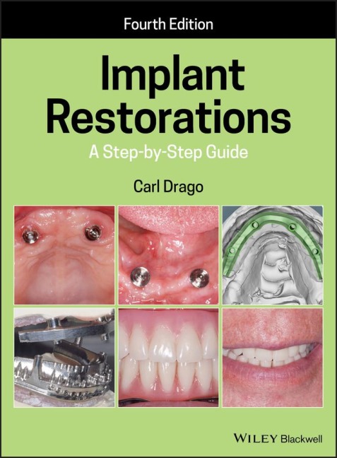 Implant Restorations: A Step-By-Step Guide
