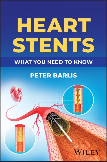 Heart Stents: What You Need to Know