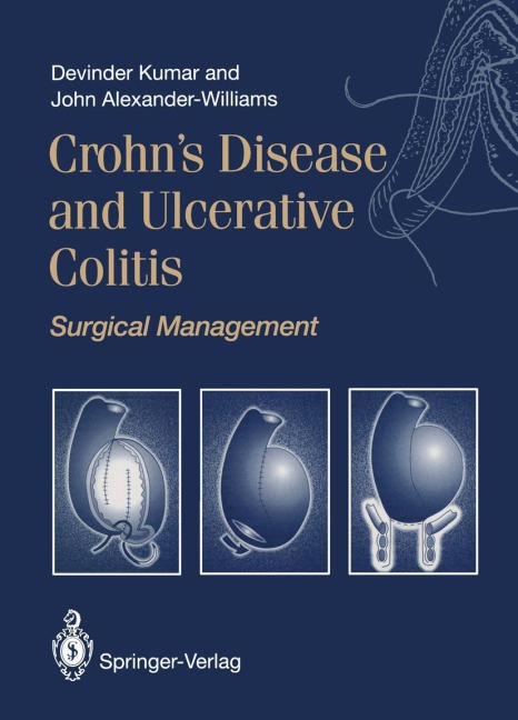 Crohns Disease and Ulcerative Colitis: Surgical Management