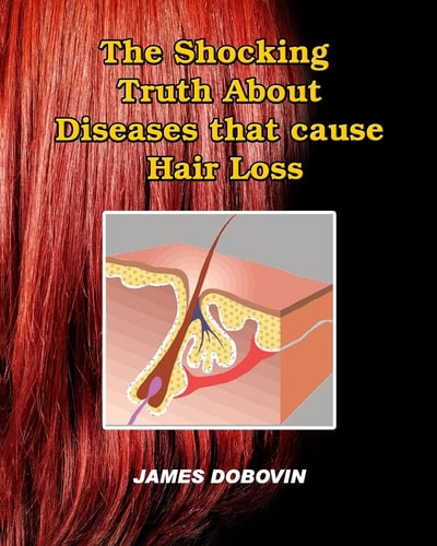 The Shocking Truth About Diseases that Cause Hair Loss Secrets You Need to Know About Losing Hair So You Can Stop From Going Bald