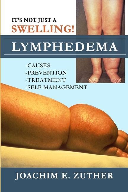Its Not Just a Swelling! Lymphedema: Causes, Prevention, Treatment, Self-Management