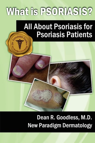 What is Psoriasis? All about Psoriasis for Psoriasis Patients