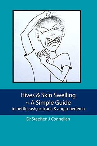 Hives and Skin Swelling ~ a Simple Guide To Nettle Rash,urticaria and Angio-Oedema