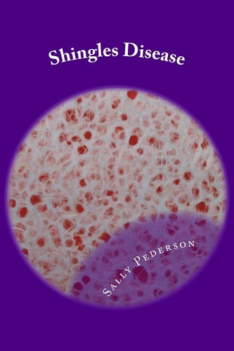 Shingles Disease The Complete Guide