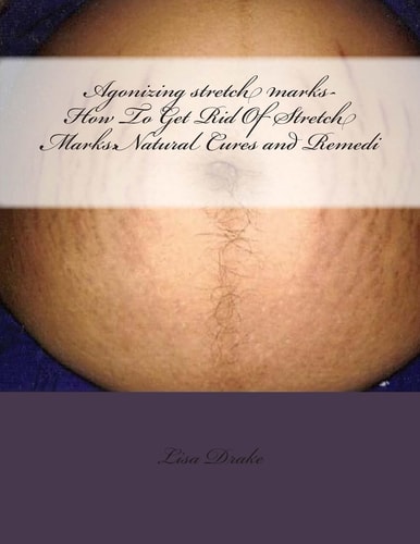 Agonizing Stretch Marks-How To Get Rid Of Stretch Marks Natural Cures and Remedi
