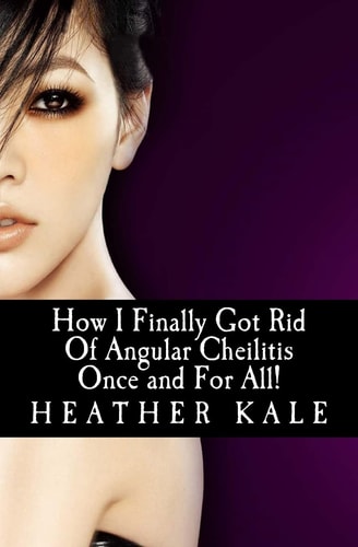 How I Finally Got Rid Of Angular Cheilitis Once and For All! Cracked Mouth Corners No More