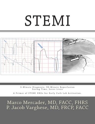 Stemi 3-Minute Diagnosis, 90-Minute Reperfusion : Saving Time, Saves Lives