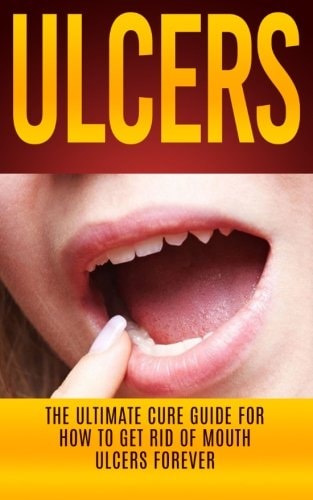 Ulcers The Ultimate Cure Guide for How to Get Rid of Mouth Ulcers Instantly