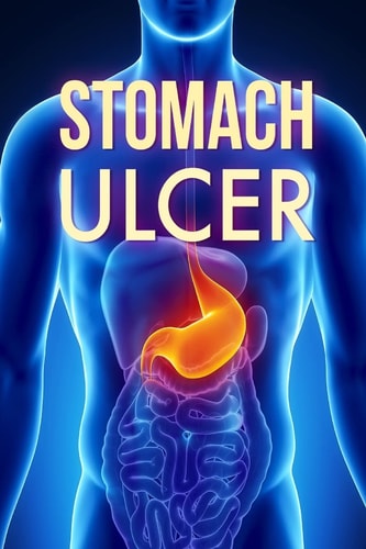 Stomach Ulcer: Treatment in 60 Days! Stomach Ulcer Treatment