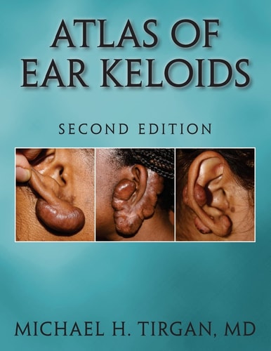 Atlas of Ear Keloids - Second Edition
