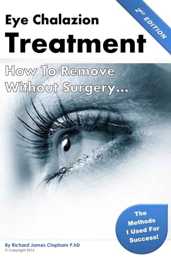 Eye Chalazion How To Remove Without Surgery: My Personal Experience and the Methods I Used for Success