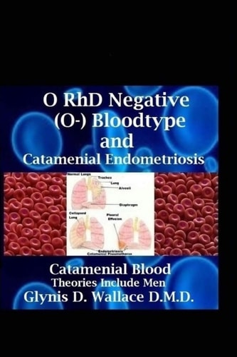 O RhD Negative (O-) Bloodtype And Catamenial Endometriosis Catamenial Blood Theories Include Men