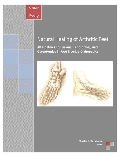 Natural Healing of Arthritic Feet Alternatives to Fusions, Tenotomies, and Osteotomies in Foot and Ankle Orthopedics