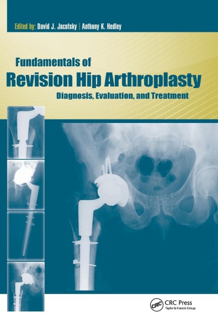 Fundamentals of Revision Hip Arthroplasty: Diagnosis, Evaluation, and Treatment