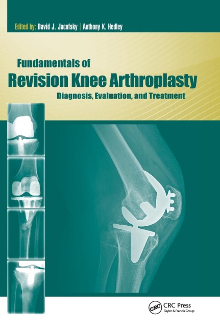 Fundamentals of Revision Knee Arthroplasty: Diagnosis, Evaluation, and Treatment