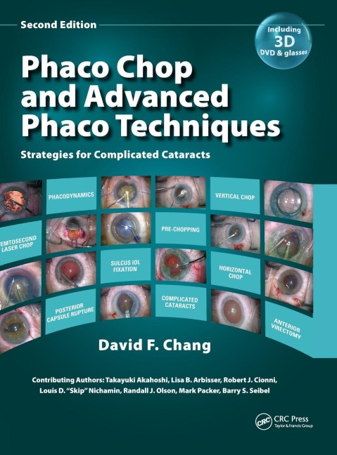 Phaco Chop and Advanced Phaco Techniques: Strategies for Complicated Cataracts