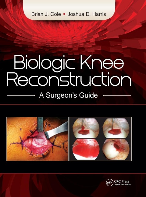 Biologic Knee Reconstruction: A Surgeons Guide