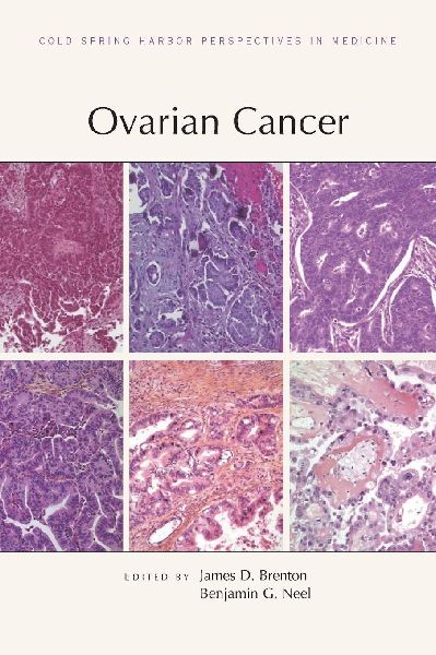 Ovarian Cancer