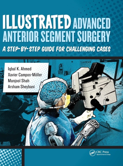 Illustrated Advanced Anterior Segment Surgery: A Step-by-Step Guide for Challenging Cases