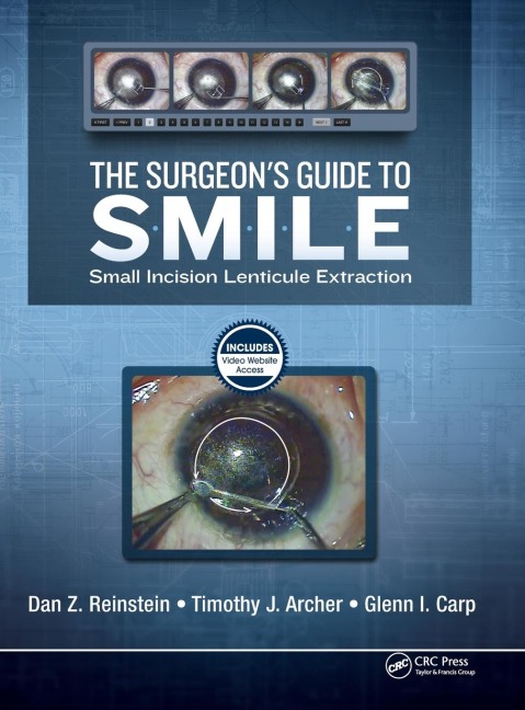 The Surgeons Guide to SMILE: Small Incision Lenticule Extraction