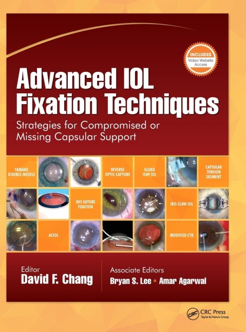 Advanced IOL Fixation Techniques: Strategies for Compromised or Missing Capsular Support