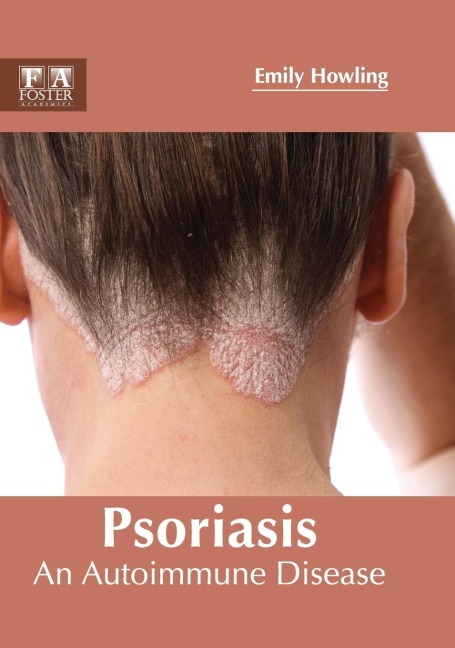 Psoriasis: An Autoimmune Disease