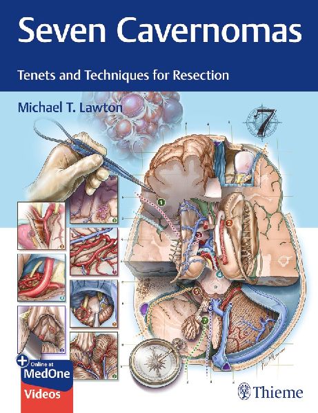 Seven Cavernomas: Tenets and Techniques for Resection