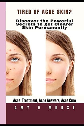 TIRED of ACNE SKIN? Discover the Powerful Secrets to Get Clearer Skin Permanently