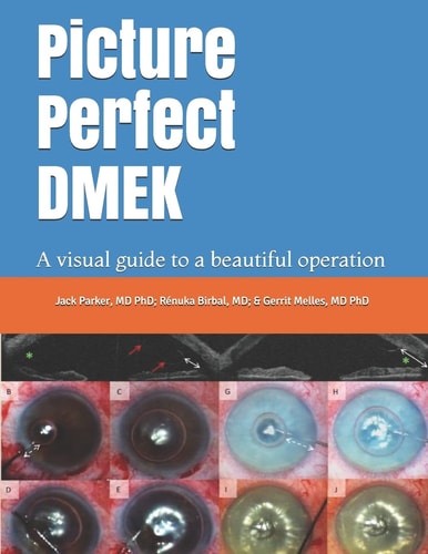 Picture Perfect Dmek A Visual Guide to a Beautiful Operation