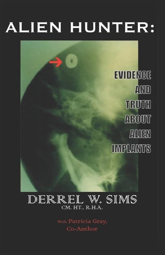 Alien Implants Evidence & Truth about Alien Implants