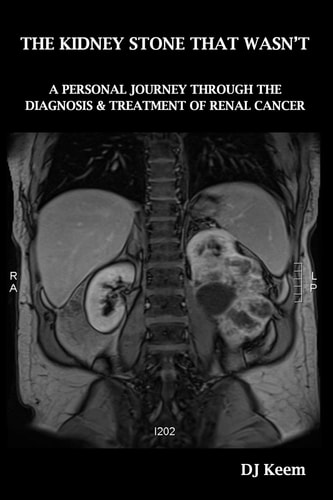The Kidney Stone That Wasn't A Personal Journey Through The Diagnosis & Treatment of Renal Cancer