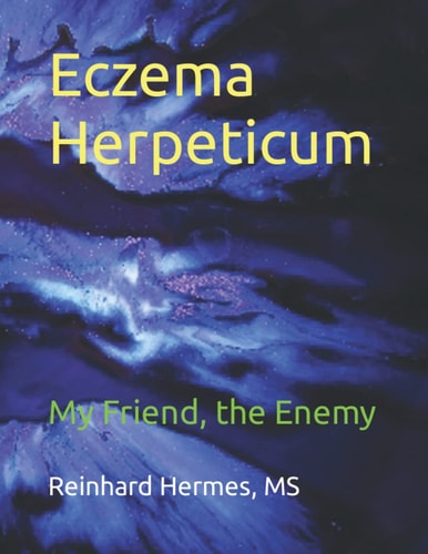 Eczema Herpeticum My Friend, the Enemy