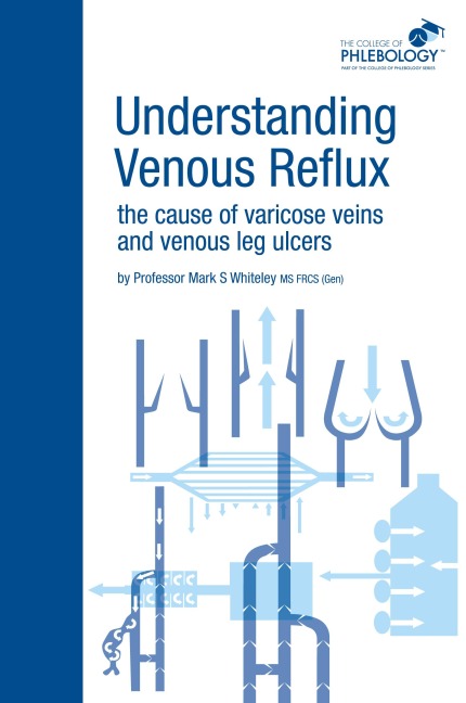 Understanding Venous Reflux the Cause of Varicose Veins and Venous Leg Ulcers: Varicose veins and venous leg ulcers