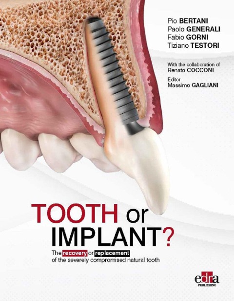 Tooth or Implant?