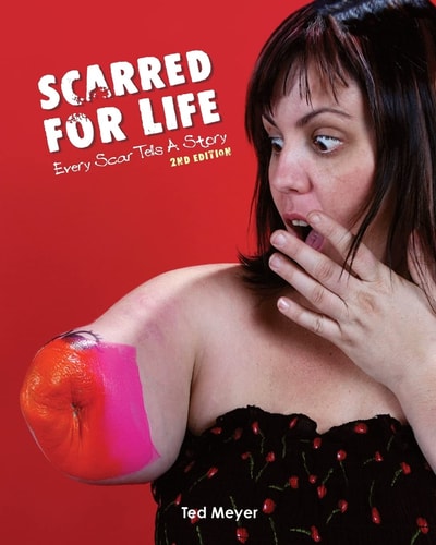 Scarred for Life. 2nd Edition Every Scar Tells a Story
