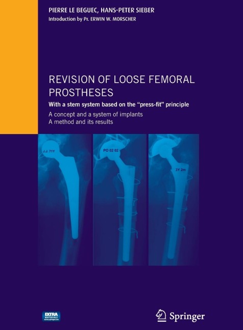 Revision of Loose Femoral Prostheses with a Stem System Based on the Press-Fit Principle: A Concept and Its System of Implants, a Method and Its Results