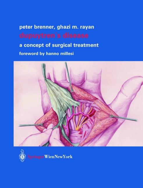 Dupuytrens Disease: A Concept of Surgical Treatment