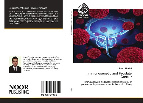 Immunogenetic and Prostate Cancer: Immunogenetic and histopathological study of patients with prostate cancer in the south of Iraq
