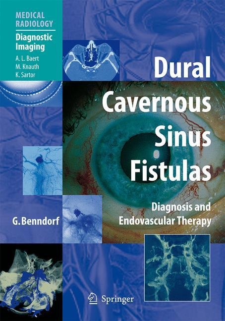 Dural Cavernous Sinus Fistulas: Diagnosis and Endovascular Therapy
