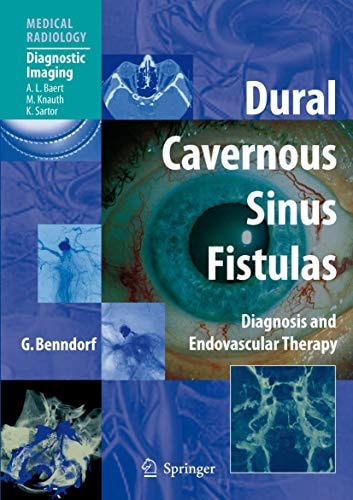 Dural Cavernous Sinus Fistulas Diagnosis and Endovascular Therapy